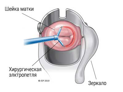 Реферат: Эрозии шейки матки